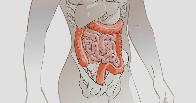 inflamação intestinal