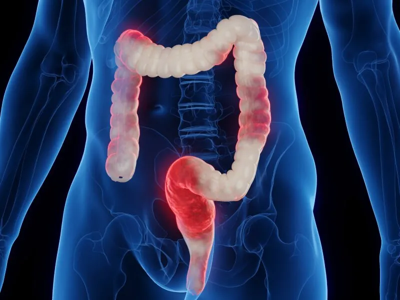 inflamação intestinal